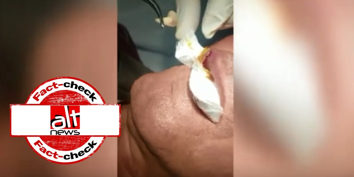Video of parasite removal from a person's lip falsely linked with Coronavirus - Alt News
